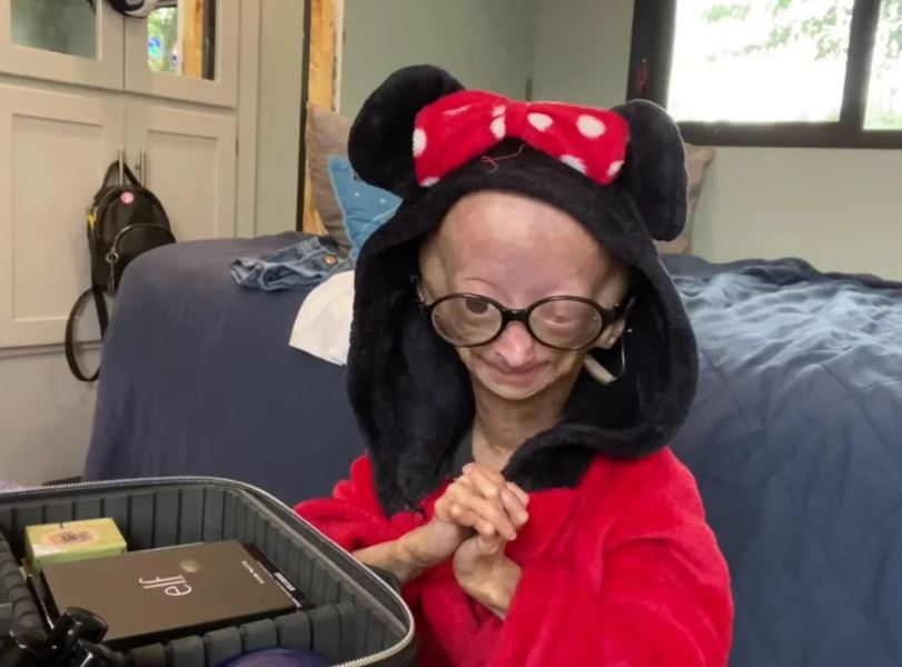 Benjamin Button hastalığıyla mücadele eden YouTuber Adalia Rose Williams hayatını kaybetti