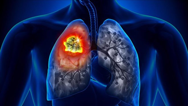 Akciğer kanserinde devrim yaratacak tedavi yöntemi